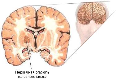 опухоль мозга