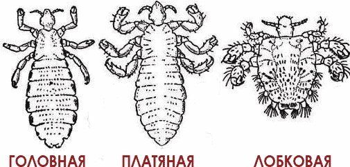 Разновидности вшей