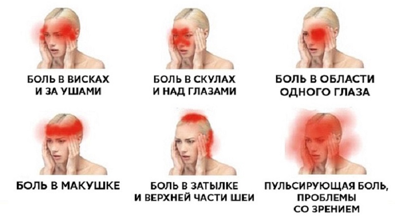 виды головной боли