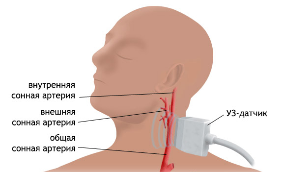 Дуплексное сканирование сосудов шеи и головы