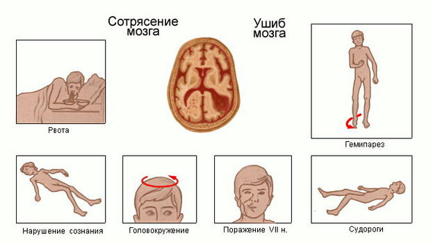 Сотрясение мозга у ребенка симптомы