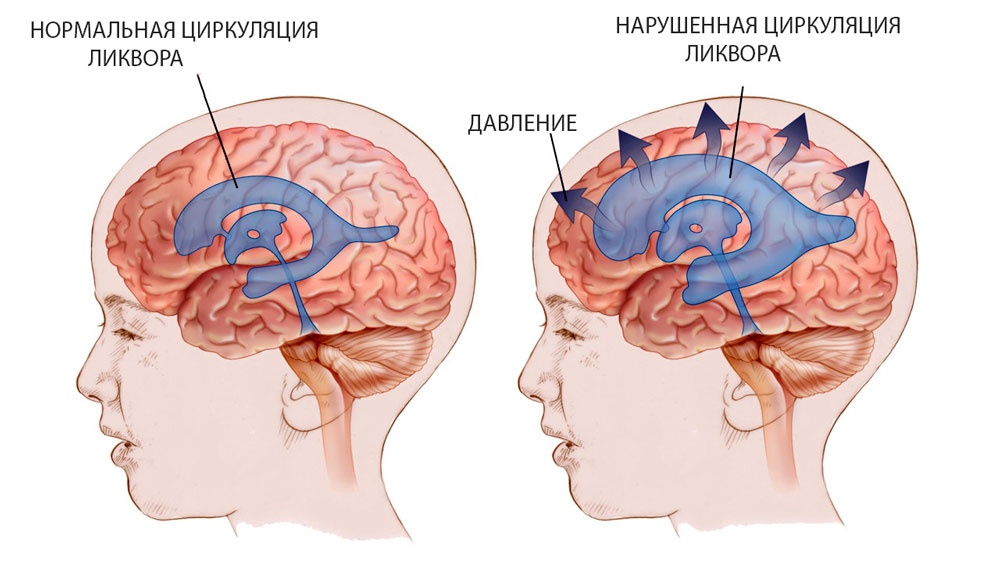 внутричерепное давление у ребенка - схема нарушения циркуляции