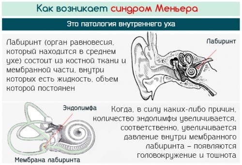 болезнь Меньера