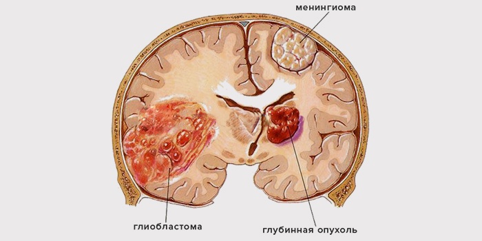 глиобластома