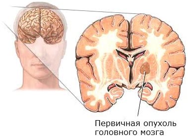 Опухоль мозга