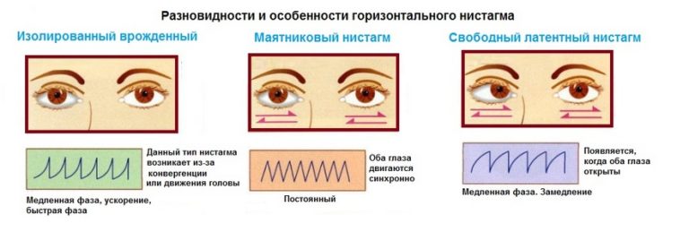 Нистагм