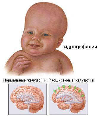 гидроцефалия