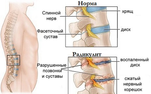 Радикулит