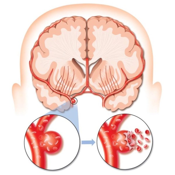разрыв аневризмы - схема
