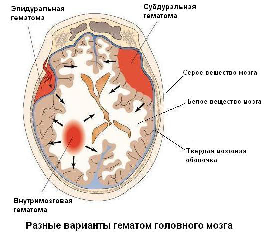 Виды гематом головного мозга