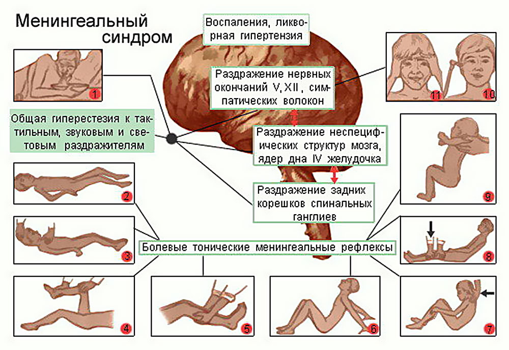 менингеальный синдром
