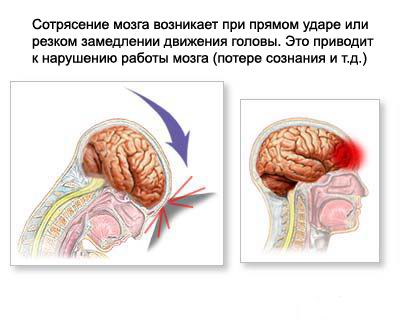 сотрясение мозга