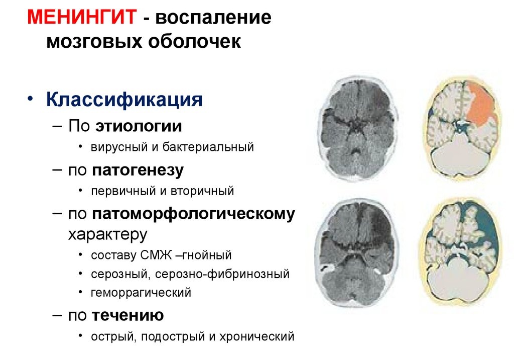 мененгит