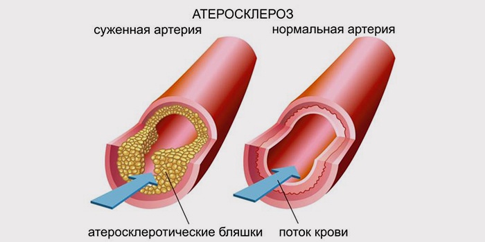 атеросклероз