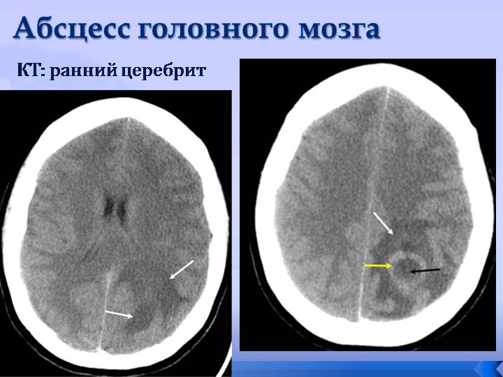 церебрит