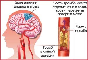 ишемия