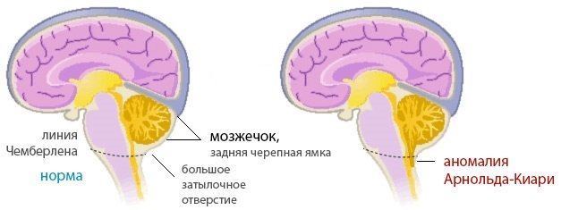 аномалия Арнольда-Кари