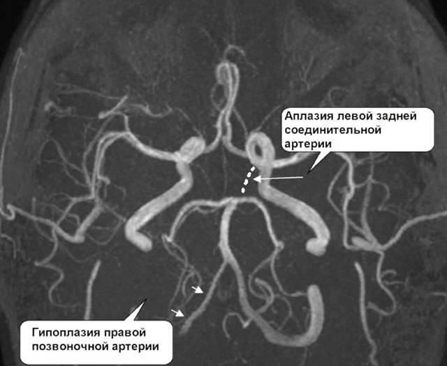 ангиография расшифровка