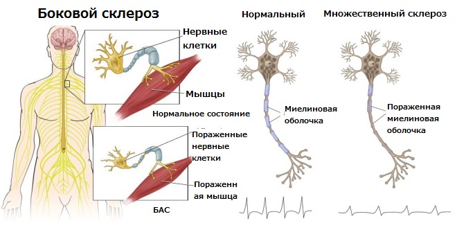 амиотрофический склероз