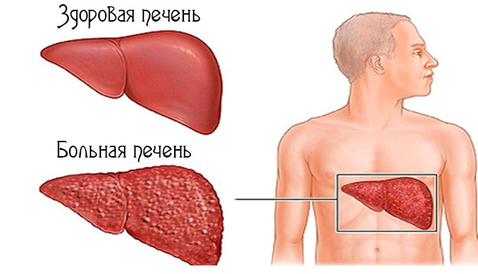 Больная печень, Болезнь Вильсона-Коновалова