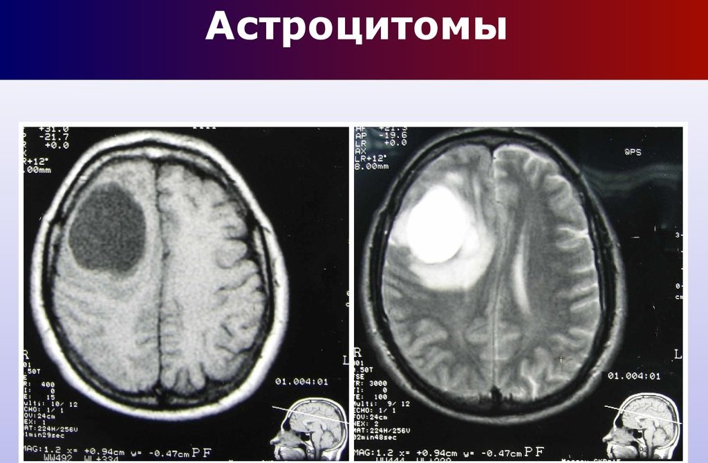 астроцитома