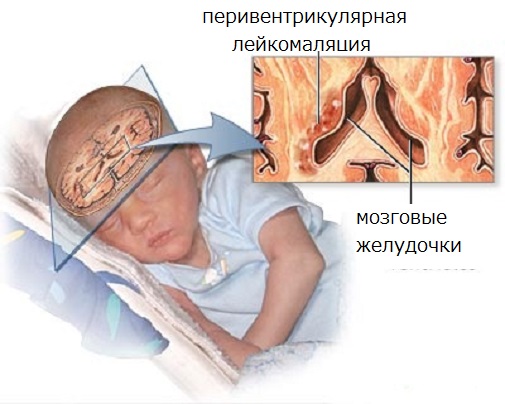 лейкоэнцефалопатия головного мозга что это такое