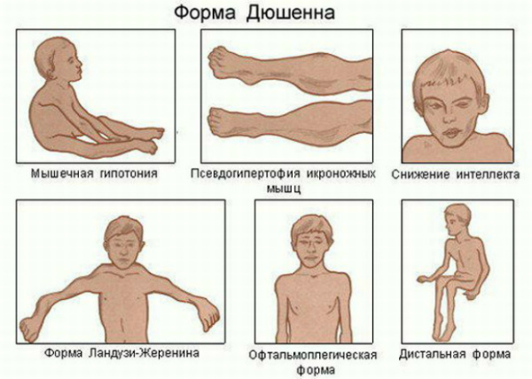 паралич Дюшена-Эрба