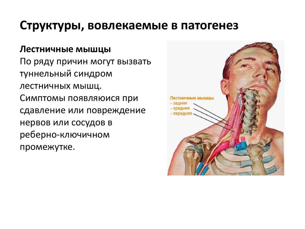 Синдром лестничной мышцы