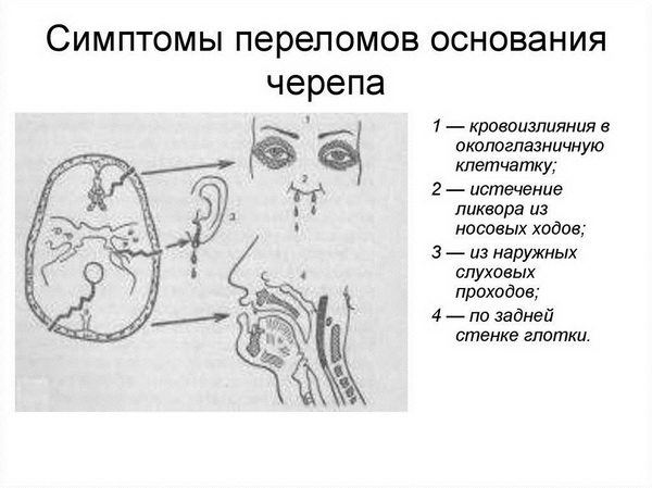 Симптомы перелома основания черепа
