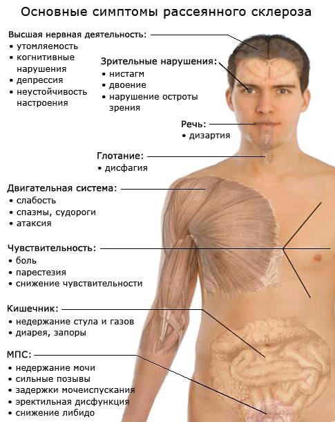 симптомы рассеянного склероза