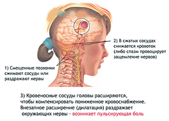 Шейная мигрень