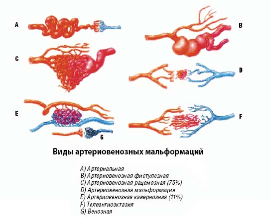 мальформация сосудов головного мозга - виды