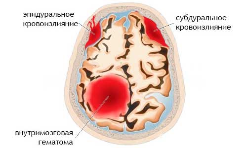 виды гематом головы