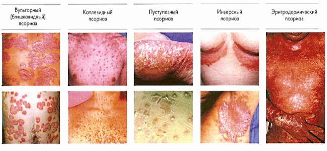Разновидность псориаза