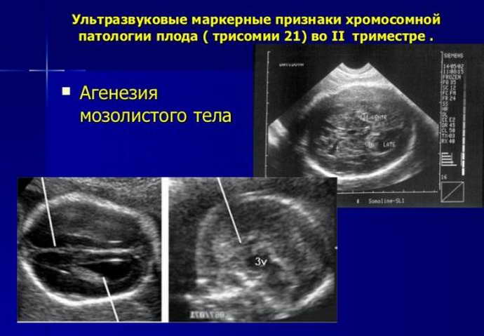 агенезия мозолистого тела