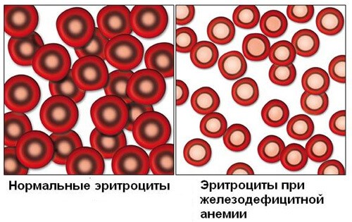 железодефицитная анемия