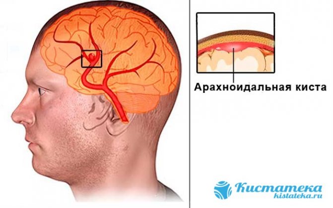 ликворная в голове