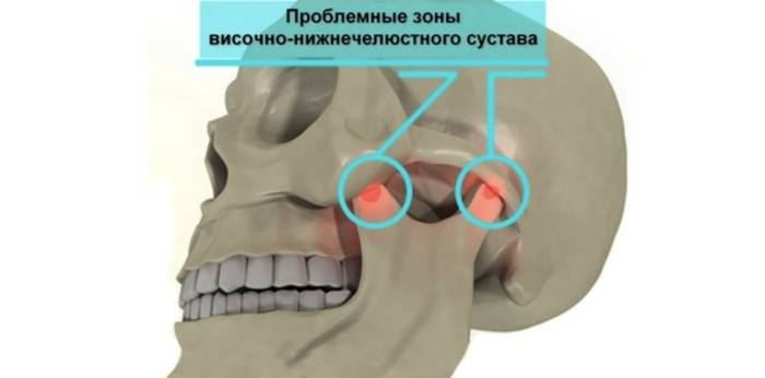 проблемные зоны височно-нижнечелюстных суставов