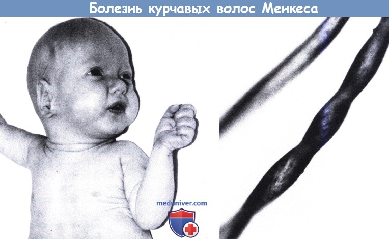 Все что нужно знать про болезнь (синдром) Менкеса