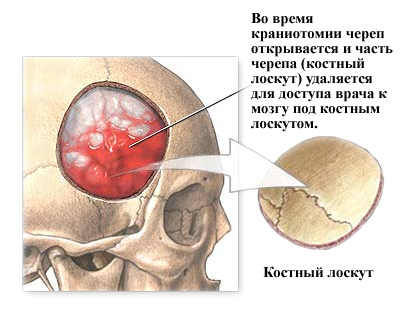 удаление фрагмента черепа