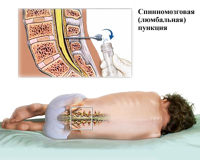 Люмбальная пункция