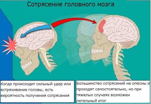сотрясение головного мозга