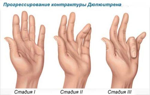 Контрактура