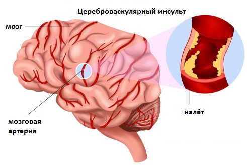Цереброваскулярный инсульт