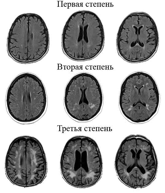 Стадии лейкоареоза