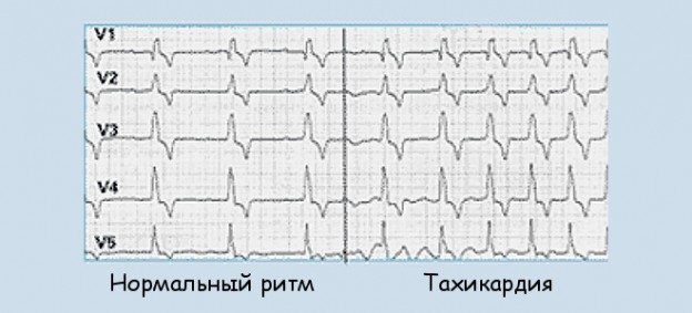 тахикардия