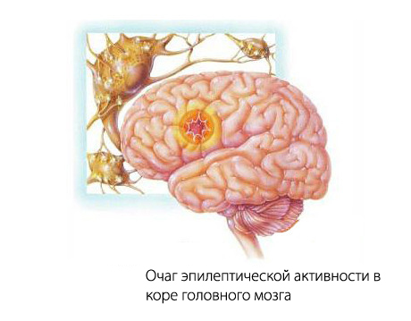 эпилептический очаг в мозге