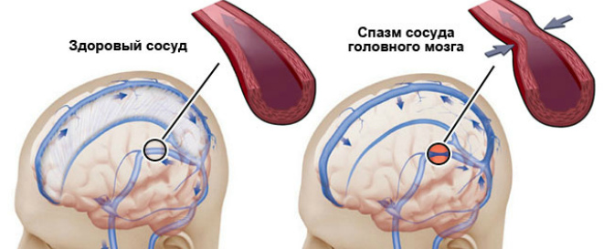 спазм сосудов