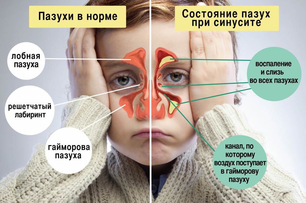 воспаление пазух