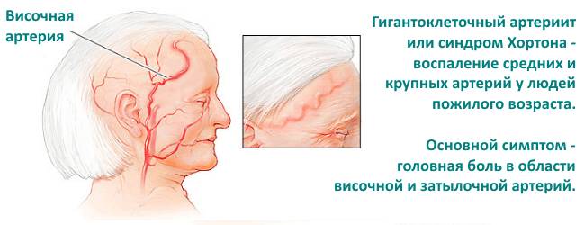 Височный артериит